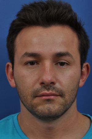 Rhinoplasty Specialist Dr. Langsdon Reveals Stunning Transformations!