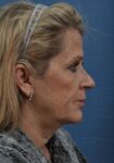 Before Deep Plane Facelift side Memphis, TN | The Langsdon Clinic