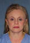 After Deep Plane Facelift Memphis, TN | The Langsdon Clinic