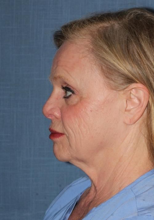 Before Deep Plane Facelift side Memphis, TN | The Langsdon Clinic