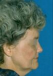 Before Deep Plane Facelift side Memphis, TN | The Langsdon Clinic