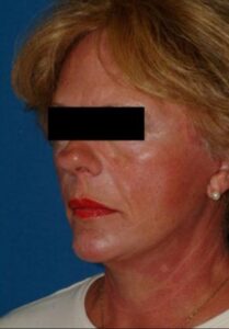 After Deep Plane Facelift Memphis, TN | The Langsdon Clinic