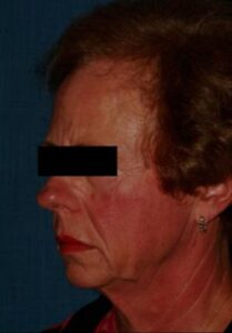 Before Deep Plane Facelift Memphis, TN | The Langsdon Clinic