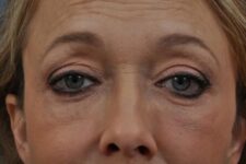 After Deep Plane Facelift Memphis, TN | The Langsdon Clinic
